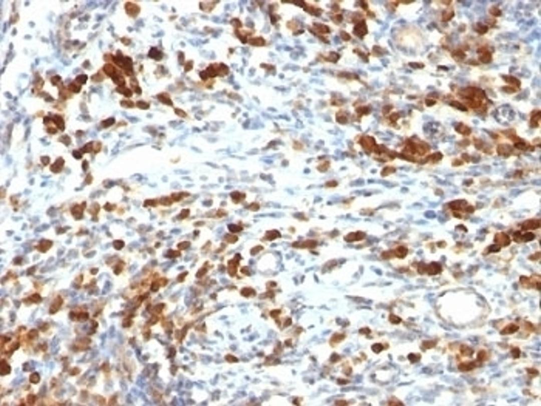 Formalin-fixed, paraffin-embedded human lymphoma stained with CD79a antibody (IGA/764).