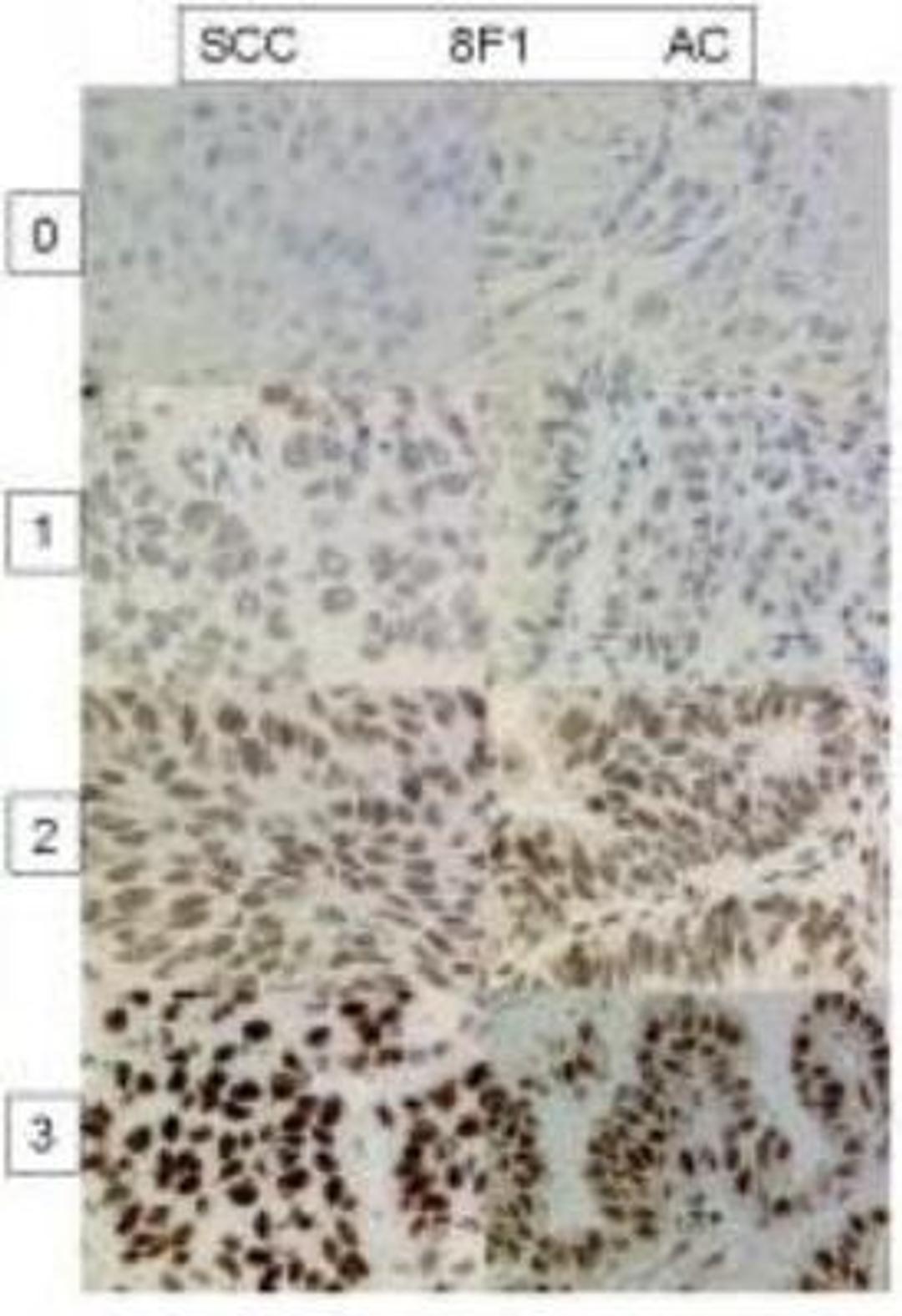 Immunohistochemistry-Paraffin: ERCC1 Antibody (8F1) [NB500-704] - Analysis of ERCC1 in human non-small cell lung cancer. Image courtesy of product review submitted by Alex Soltermann.