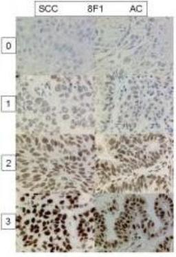 Immunohistochemistry-Paraffin: ERCC1 Antibody (8F1) [NB500-704] - Analysis of ERCC1 in human non-small cell lung cancer. Image courtesy of product review submitted by Alex Soltermann.