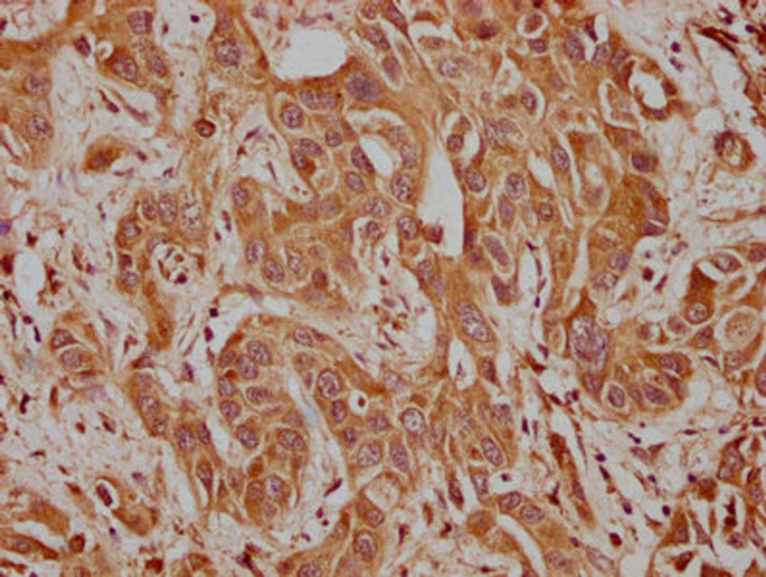 IHC image of CSB-PA004397LA01HU diluted at 1:100 and staining in paraffin-embedded human liver cancer performed on a Leica BondTM system. After dewaxing and hydration, antigen retrieval was mediated by high pressure in a citrate buffer (pH 6.0). Section was blocked with 10% normal goat serum 30min at RT. Then primary antibody (1% BSA) was incubated at 4°C overnight. The primary is detected by a biotinylated secondary antibody and visualized using an HRP conjugated SP system.