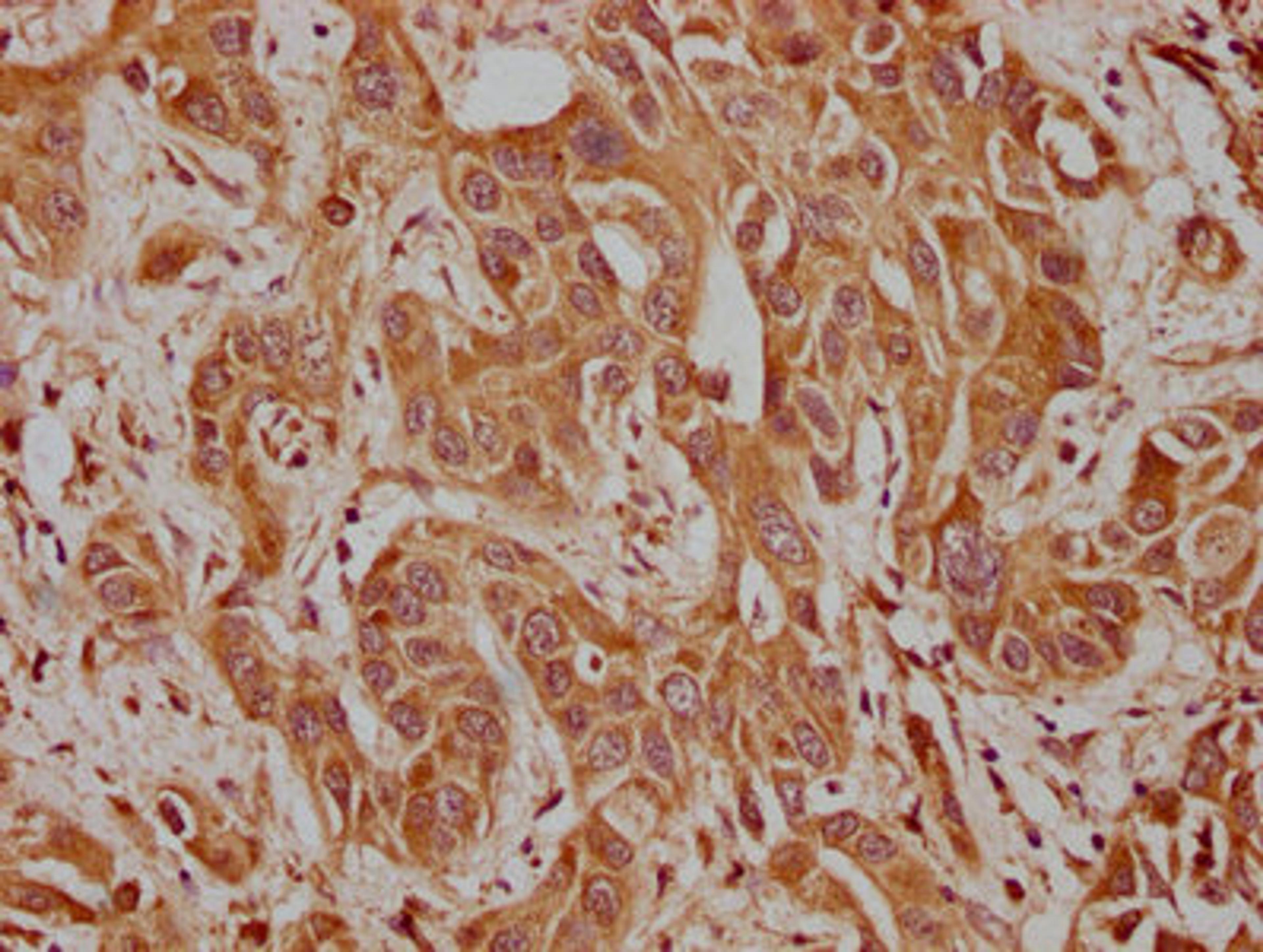 IHC image of CSB-PA004397LA01HU diluted at 1:100 and staining in paraffin-embedded human liver cancer performed on a Leica BondTM system. After dewaxing and hydration, antigen retrieval was mediated by high pressure in a citrate buffer (pH 6.0). Section was blocked with 10% normal goat serum 30min at RT. Then primary antibody (1% BSA) was incubated at 4°C overnight. The primary is detected by a biotinylated secondary antibody and visualized using an HRP conjugated SP system.