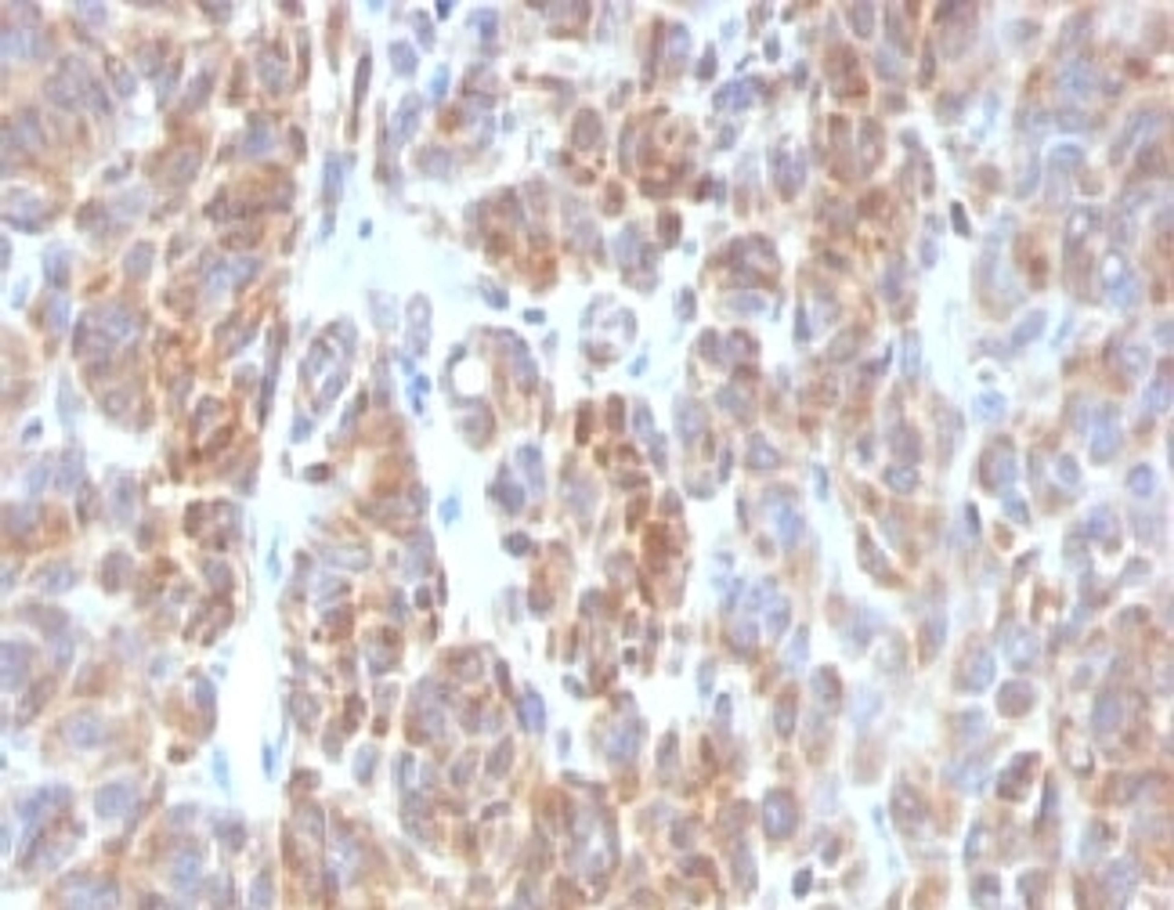 IHC testing of FFPE human melanoma with Bcl2 antibody (clone ARBC2-1)