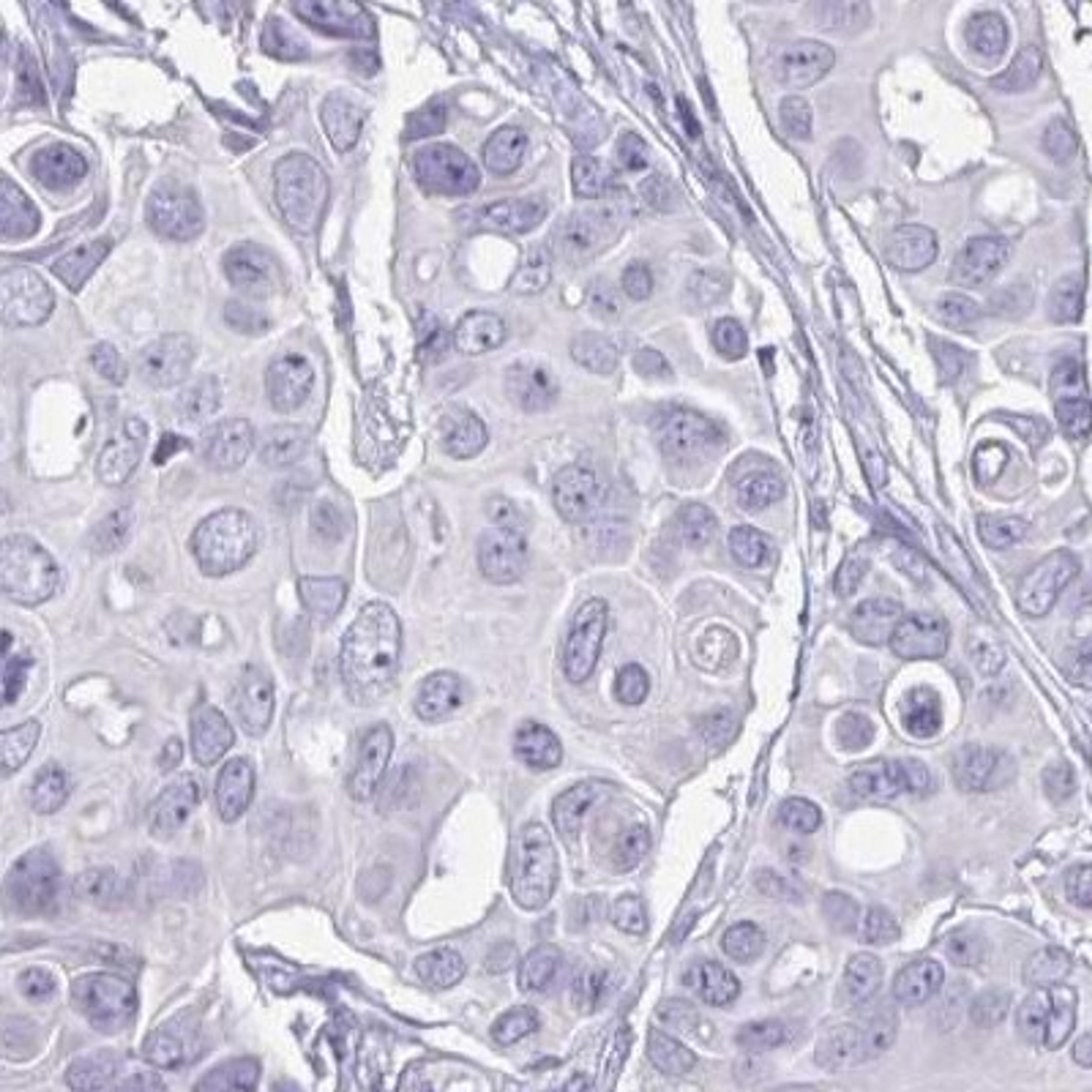 Immunohistochemistry: Testis serine protease 5 Antibody [NBP2-31815] - breast cancer