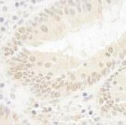 Immunohistochemistry-Paraffin: DOT1L Antibody [NB100-40845] - FFPE section of human colon carcinoma..