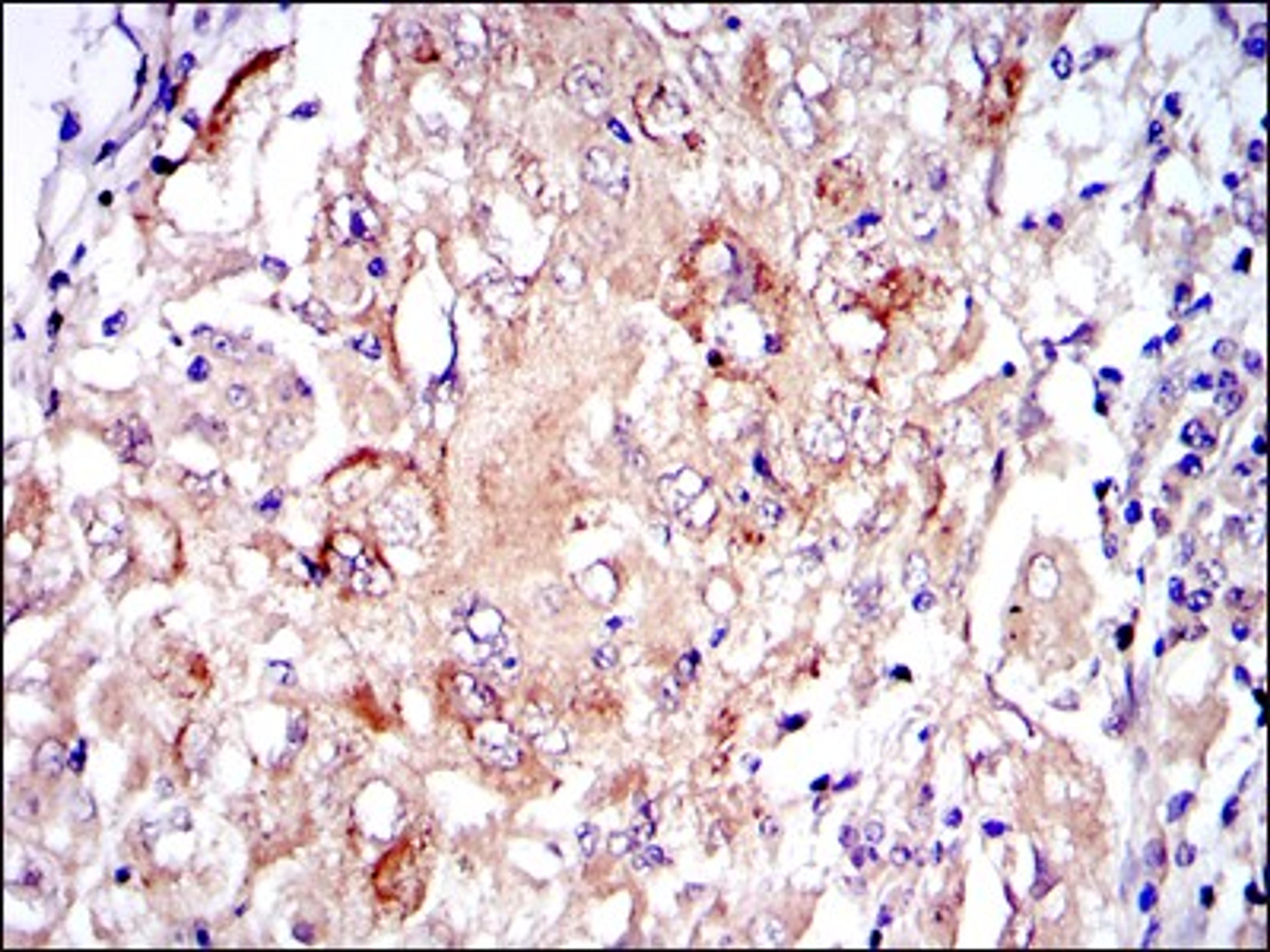 Immunohistochemistry: PKN2 Antibody (1D1) [NBP2-37573] - Immunohistochemical analysis of paraffin-embedded lung cancer tissues using PRK2 mouse mAb with DAB staining.