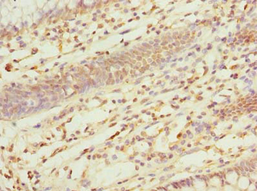 Immunohistochemistry of paraffin-embedded human colon cancer using CSB-PA861196LA01HU at dilution of 1:100