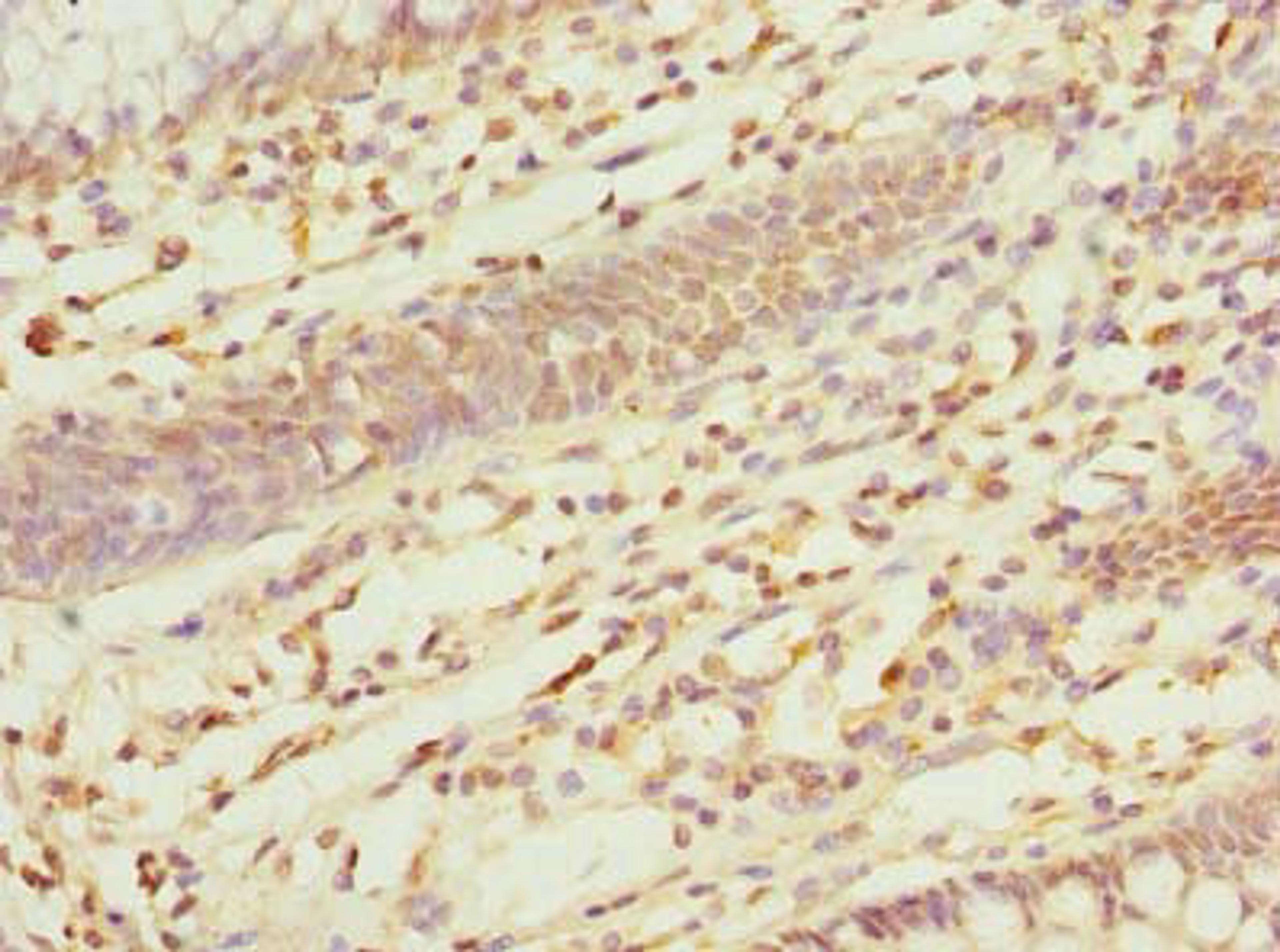Immunohistochemistry of paraffin-embedded human colon cancer using CSB-PA861196LA01HU at dilution of 1:100