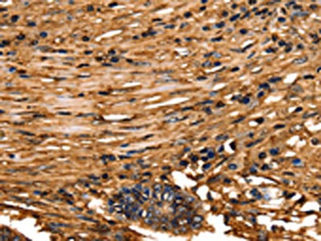 The image on the left is immunohistochemistry of paraffin-embedded Human colon cancer tissue using CSB-PA297927(ANXA5 Antibody) at dilution 1/40, on the right is treated with fusion protein. (Original magnification: ×200)