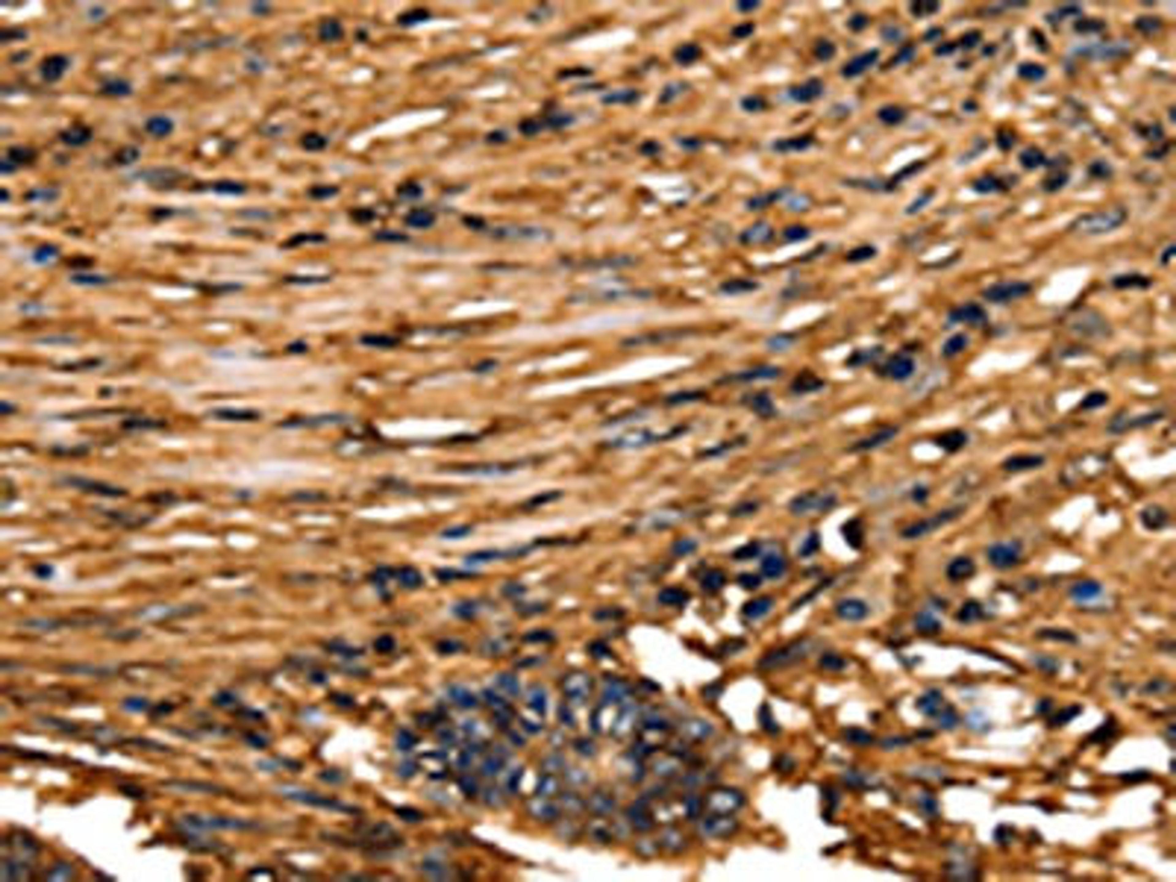 The image on the left is immunohistochemistry of paraffin-embedded Human colon cancer tissue using CSB-PA297927(ANXA5 Antibody) at dilution 1/40, on the right is treated with fusion protein. (Original magnification: ×200)
