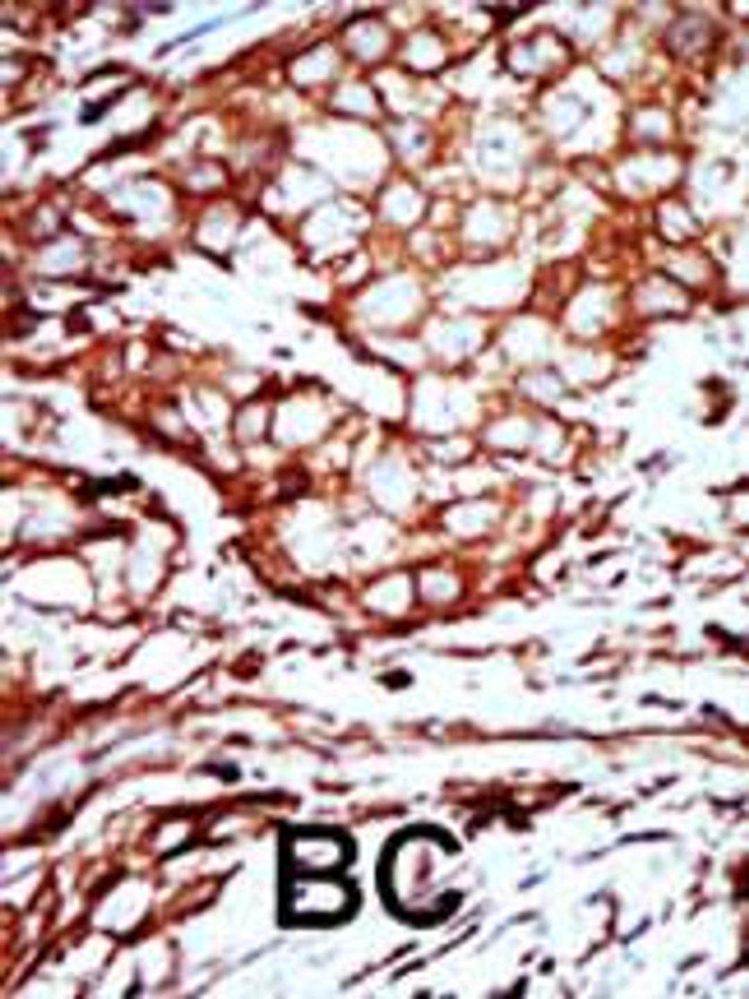 Formalin-fixed and paraffin-embedded human cancer tissue reacted with the primary antibody, which was peroxidase-conjugated to the secondary antibody, followed by AEC staining. BC = breast carcinoma; HC = hepatocarcinoma.