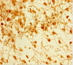 Immunohistochemistry of paraffin-embedded human melanoma using CSB-PA859108LA01HU at dilution of 1:100