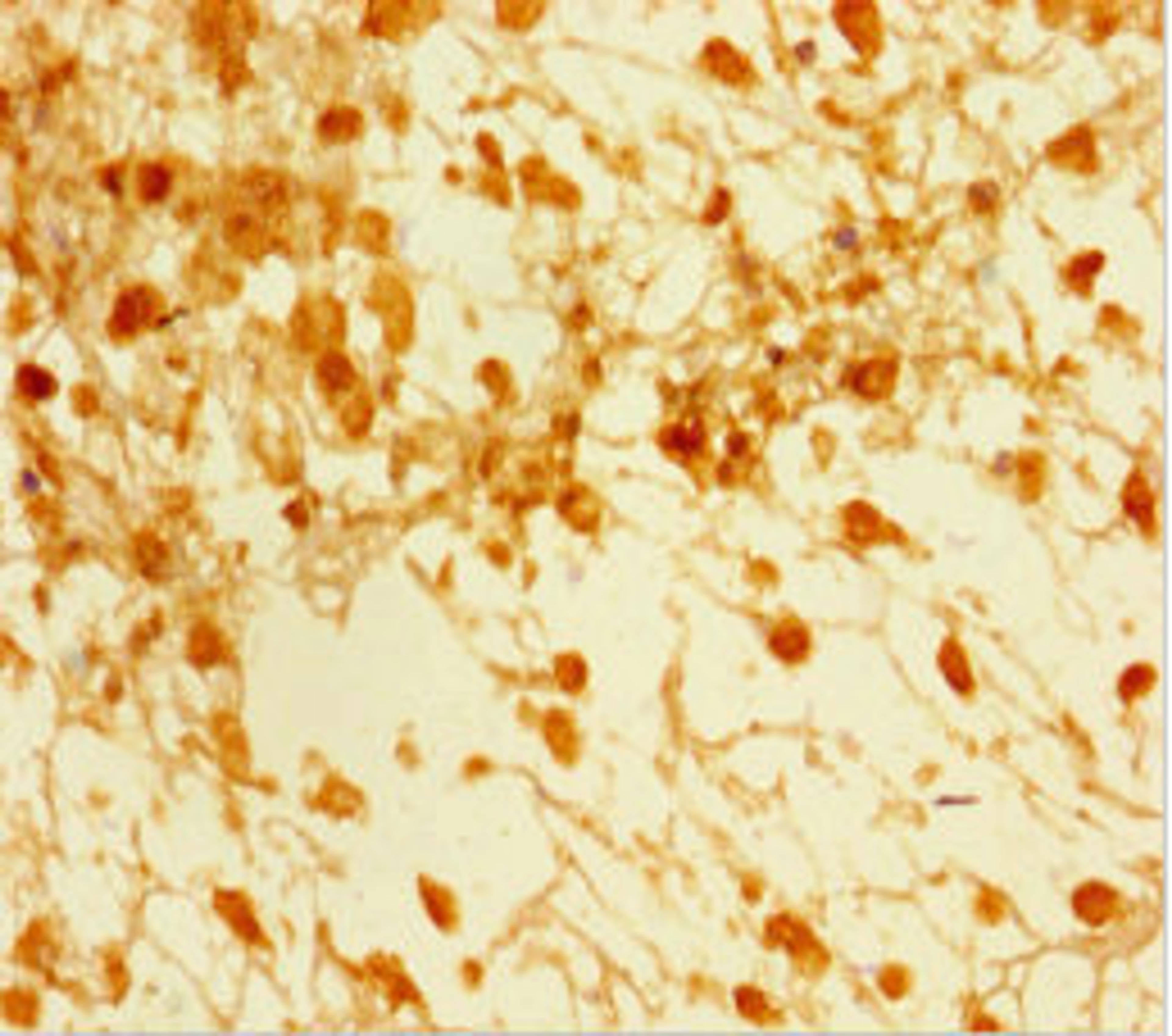 Immunohistochemistry of paraffin-embedded human melanoma using CSB-PA859108LA01HU at dilution of 1:100