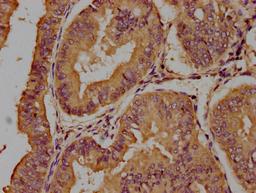 IHC image of CSB-PA023309OA01HU diluted at 1:100 and staining in paraffin-embedded human endometrial cancer performed on a Leica BondTM system. After dewaxing and hydration, antigen retrieval was mediated by high pressure in a citrate buffer (pH 6.0). Section was blocked with 10% normal goat serum 30min at RT. Then primary antibody (1% BSA) was incubated at 4°C overnight. The primary is detected by a biotinylated secondary antibody and visualized using an HRP conjugated SP system.