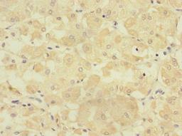 Immunohistochemistry of paraffin-embedded human gastric cancer using CSB-PA018824ESR2HU at dilution of 1:100