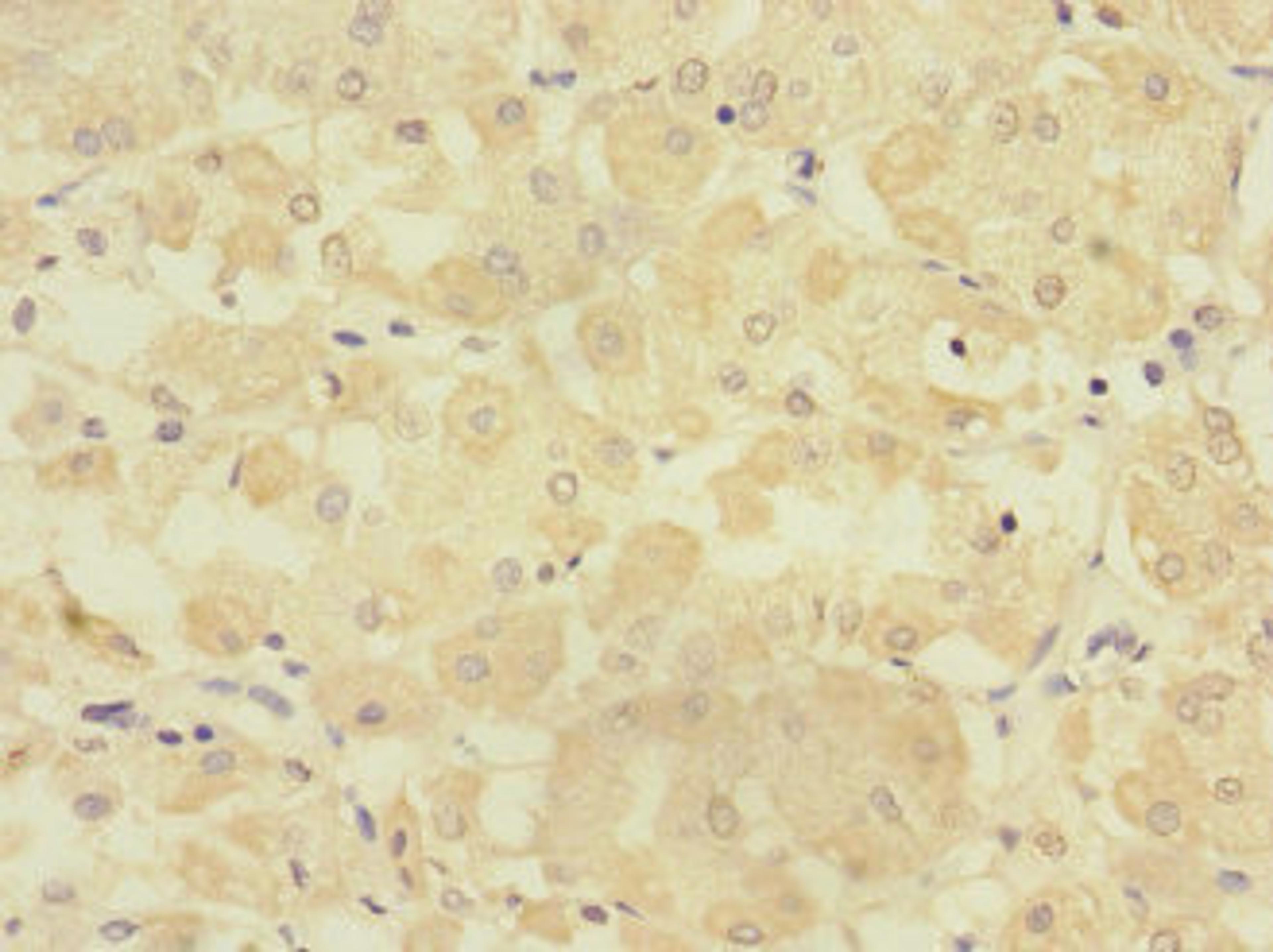Immunohistochemistry of paraffin-embedded human gastric cancer using CSB-PA018824ESR2HU at dilution of 1:100