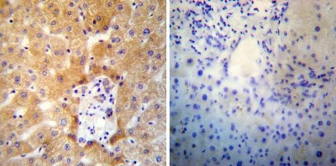 Immunohistochemistry-Paraffin: SERCA2 ATPase Antibody (2A7-A1) [NB300-581] - Both normal and cancer biopsies of deparaffinized Human liver tissues.