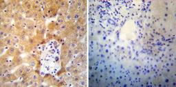 Immunohistochemistry-Paraffin: SERCA2 ATPase Antibody (2A7-A1) [NB300-581] - Both normal and cancer biopsies of deparaffinized Human liver tissues.