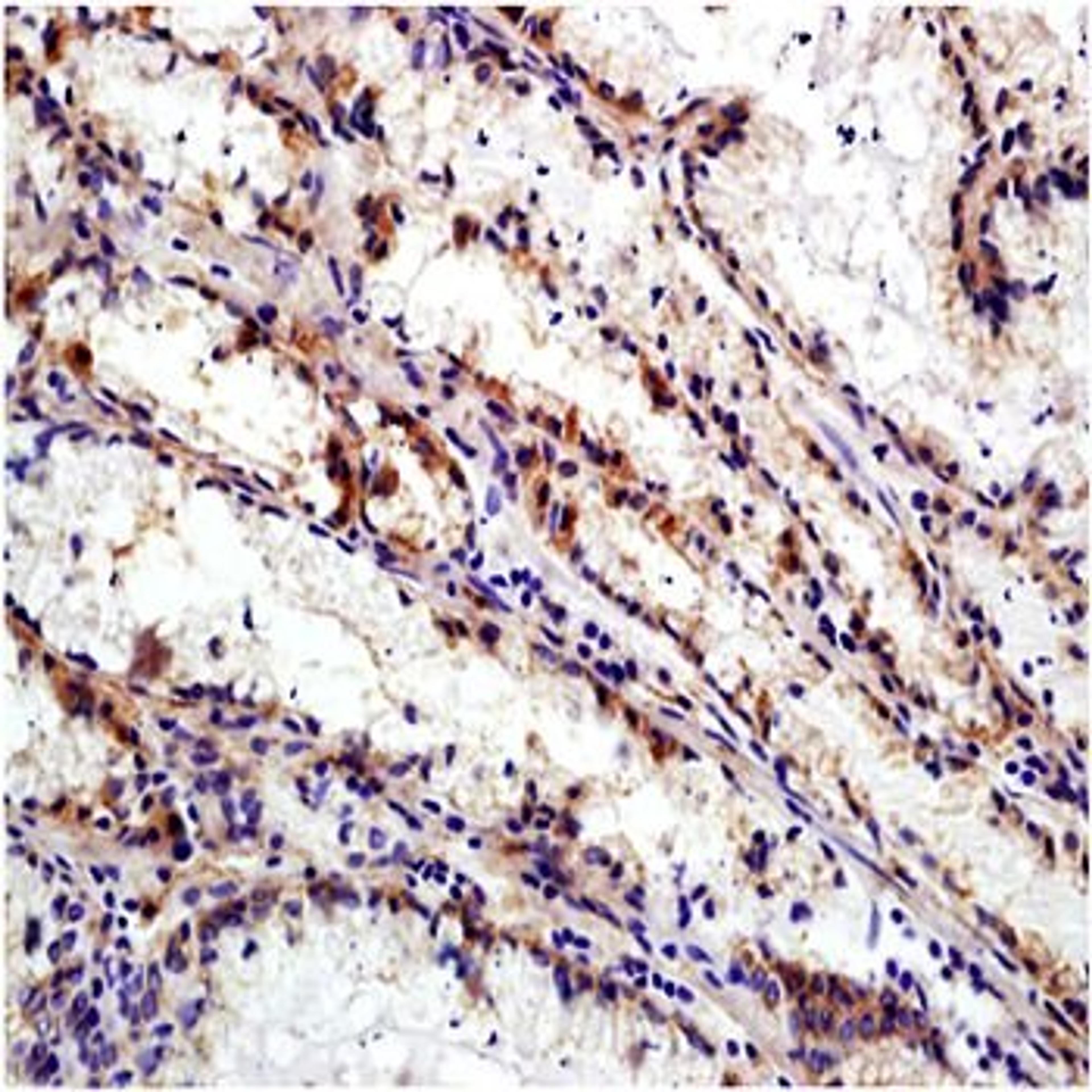 Paraffin-embedded human gastric carcinoma fixed with 4% paraformaldehyde. Antigen retrieval by boiling with citrate buffer. Blocking buffer is goat serum (37 degrees for 20 min.). Integrin Alpha V/Beta 6 antibody at 1:200 dilution with overnight incubatio