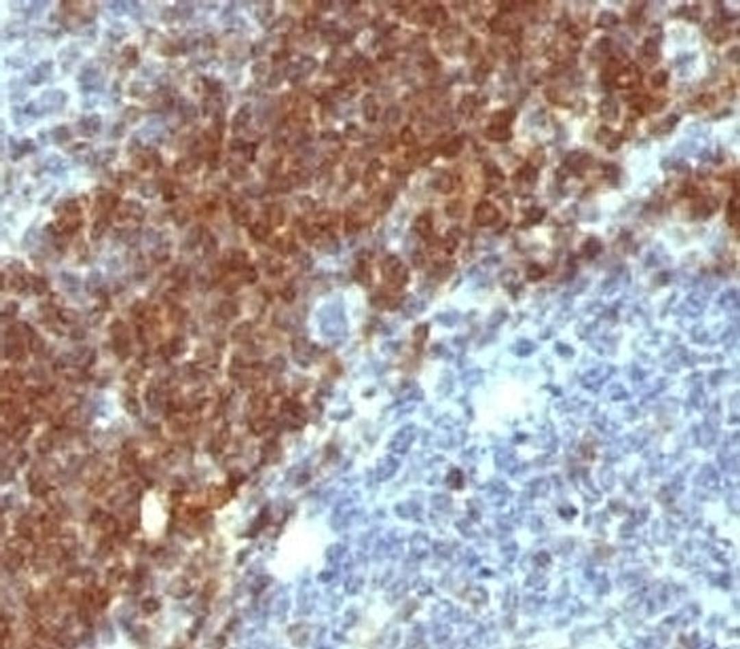 Formalin-fixed, paraffin-embedded human non-Hodgkin's lymphoma stained with anti-Bcl-2 antibody (SPM530).