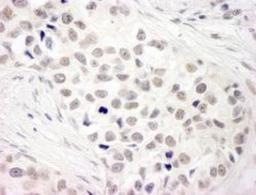 Immunohistochemistry-Paraffin: NCOA5 Antibody [NB100-2571] - Human breast carcinoma.