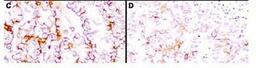 Immunohistochemistry-Paraffin: Mesothelin Antibody (MB-G10) [NB110-85538] - Human tissue sections treated by antigen retrieval methods. Primary antibodies were used to label these sections as follows: C, MAb MB; and D, MAb MN. Reprinted with permission fromClin.Cancer Res. 11(16):5840-6.