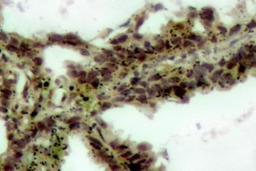 Immunohistochemistry-Paraffin: Akt1 [p Thr308] Antibody [NB100-92469] - Paraffin-embedded human lung carcinoma tissue.