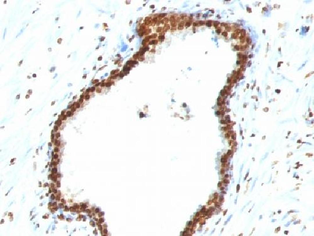 Immunohistochemical staining of human Colon carcinoma tissue using dsDNA antibody