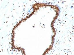 Immunohistochemical staining of human Colon carcinoma tissue using dsDNA antibody