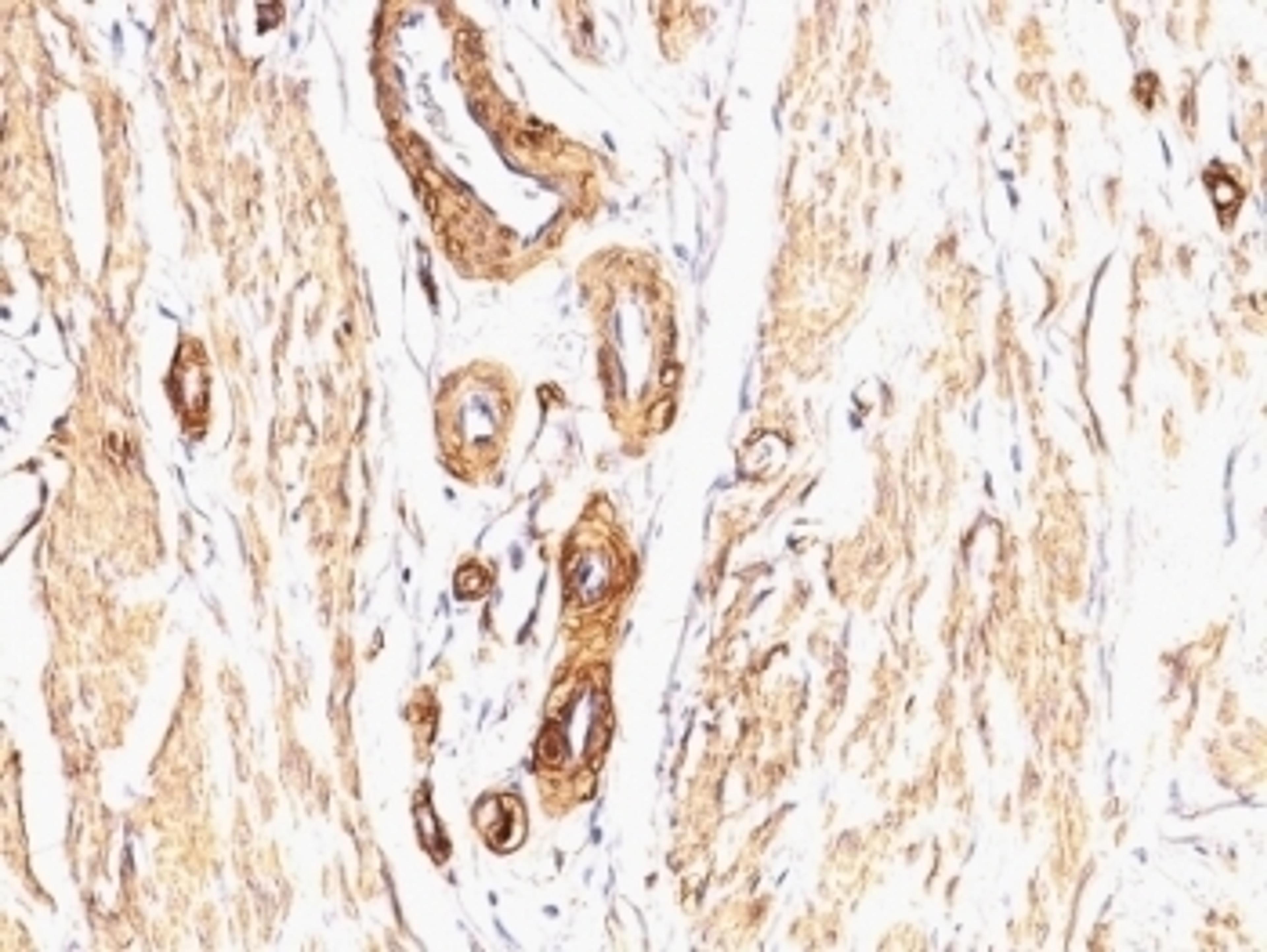 Formalin-fixed, paraffin-embedded Leiomyosarcoma stained with Smooth Muscle Actin antibody (SPM332).