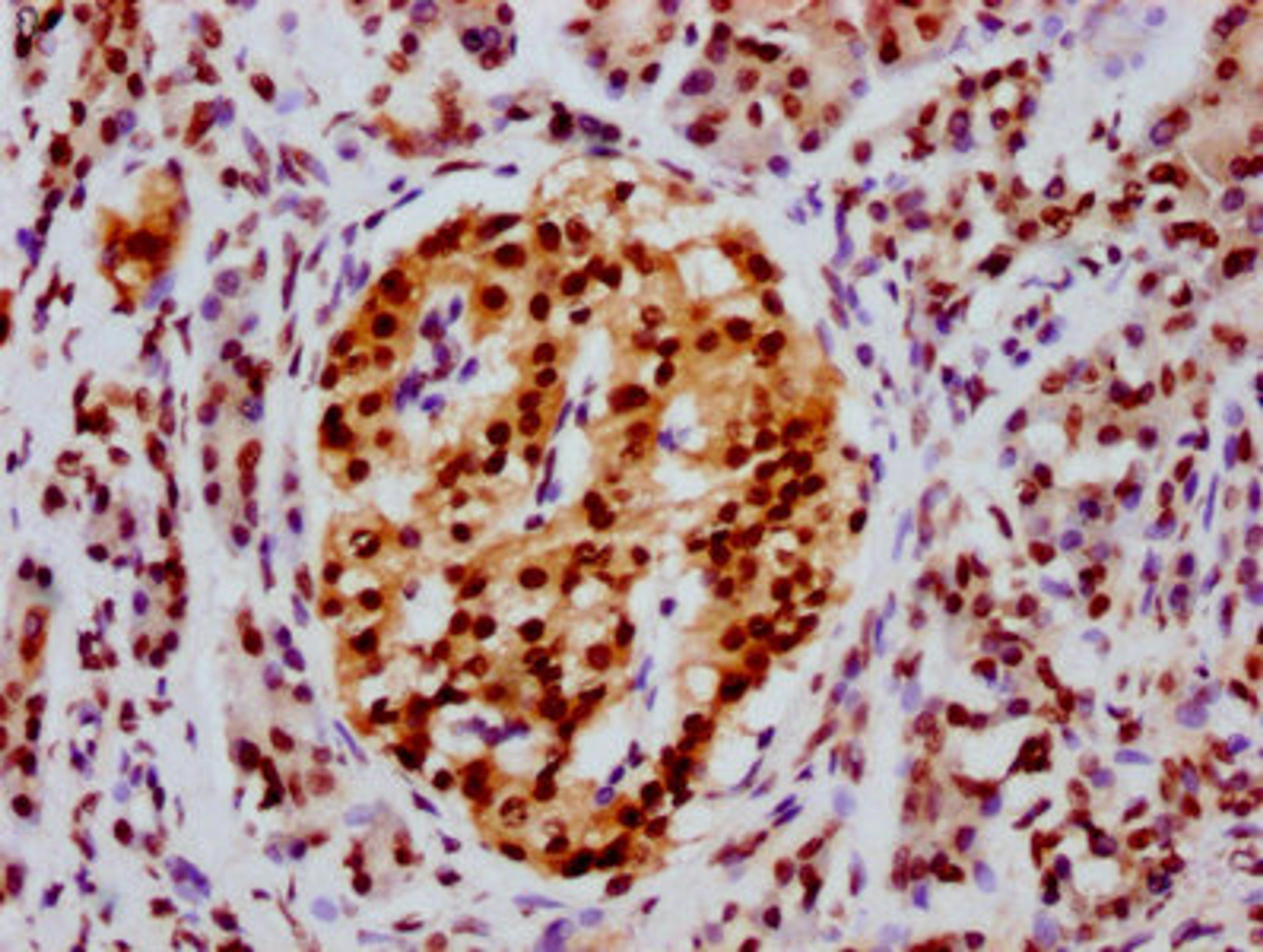 IHC image of CSB-PA010429OA91npropHU diluted at 1:20 and staining in paraffin-embedded human pancreatic cancer performed on a Leica BondTM system. After dewaxing and hydration, antigen retrieval was mediated by high pressure in a citrate buffer (pH 6.0). Section was blocked with 10% normal goat serum 30min at RT. Then primary antibody (1% BSA) was incubated at 4&deg;C overnight. The primary is detected by a biotinylated secondary antibody and visualized using an HRP conjugated SP system.