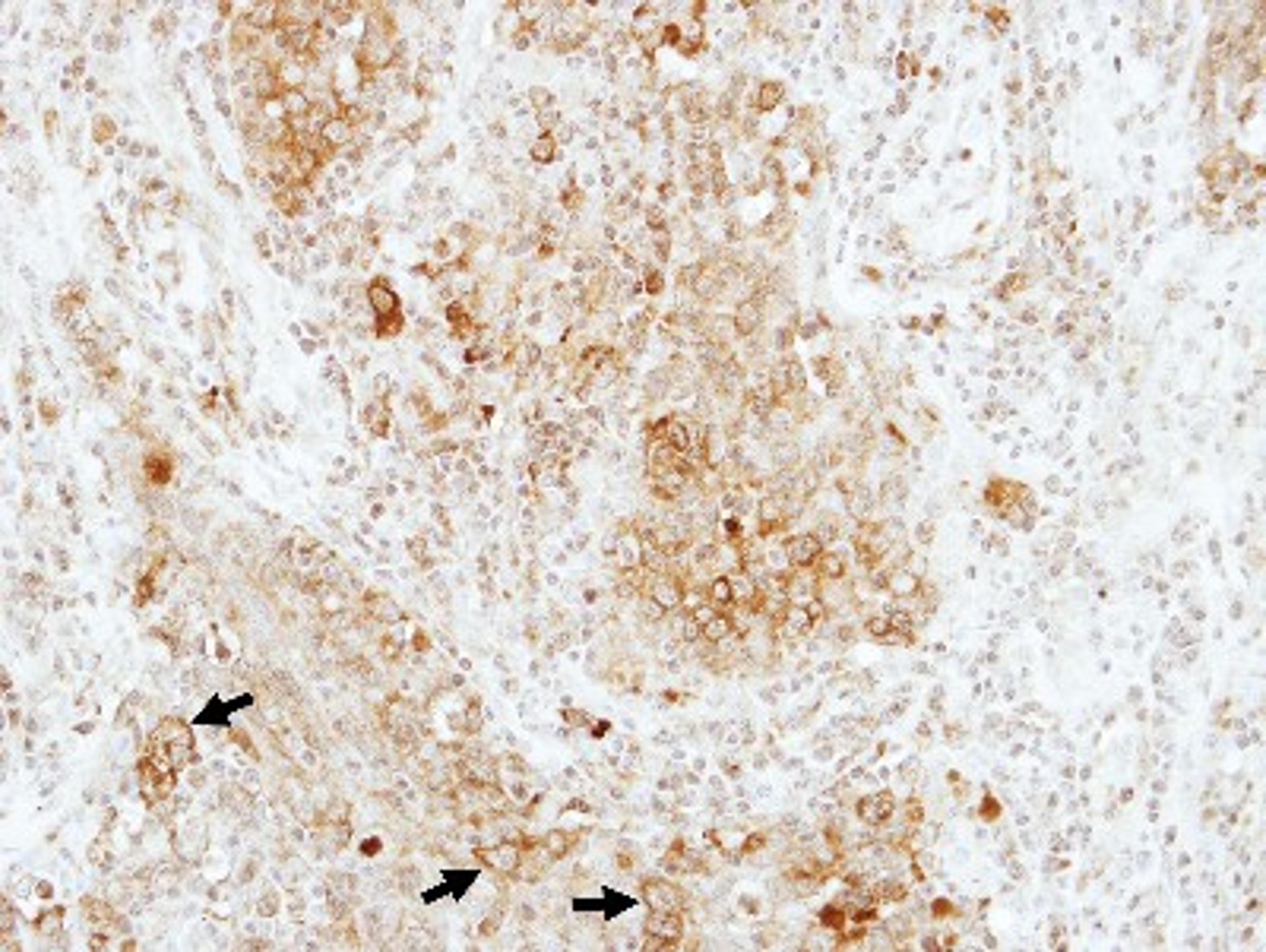 Immunohistochemistry-Paraffin: RAP1B Antibody [NBP2-20072] - Immunohistochemical analysis of paraffin-embedded lung AdCA, using antibody at 1:100 dilution.