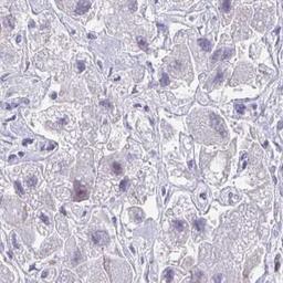 Immunohistochemistry: GALNTL1 Antibody [NBP2-31747] - liver cancer