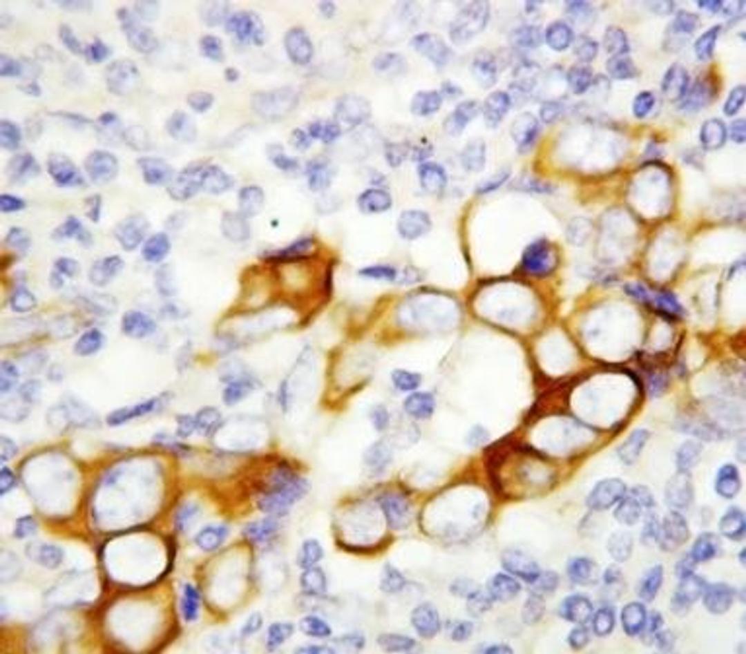 Immunohistochemical staining of paraffin embedded breast cancer tissue using Angptl4 antibody