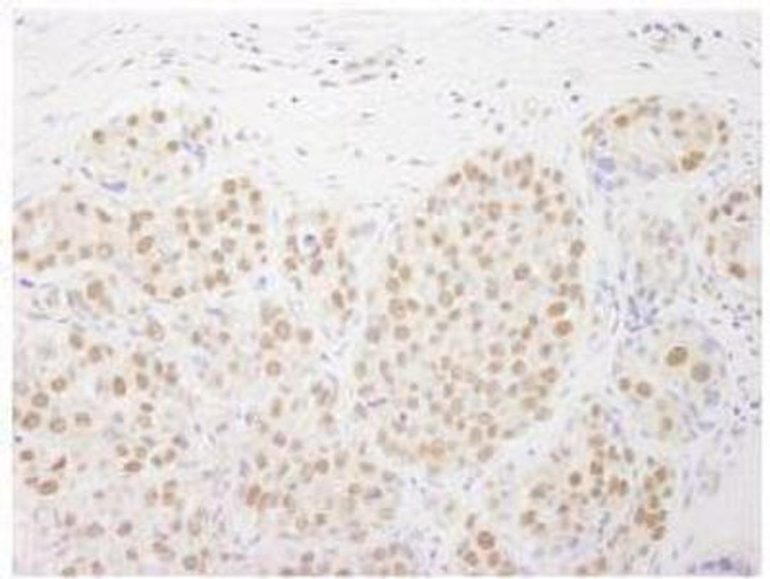 Immunohistochemistry-Paraffin: RTF1 Antibody [NB100-61052] - FFPE section of human breast carcinoma.  Affinity purified rabbit anti-Rtf1 used at a dilution of 1:250.