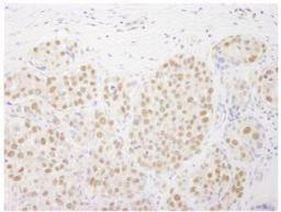 Immunohistochemistry-Paraffin: RTF1 Antibody [NB100-61052] - FFPE section of human breast carcinoma.  Affinity purified rabbit anti-Rtf1 used at a dilution of 1:250.