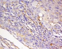 Immunohistochemical staining of human lung carcinoma tissue using nNOS (phospho-Ser847) antibody.