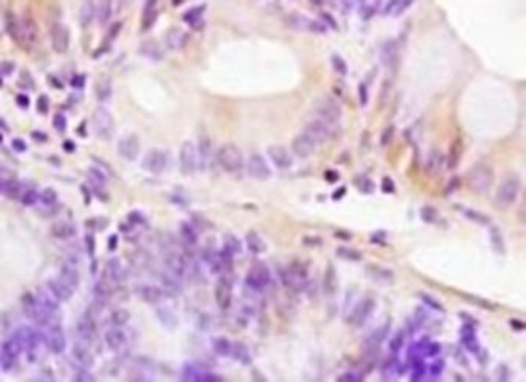 Immunohistochemical analysis of formalin-fixed paraffin embedded human colon carcinoma tissue using PDGF Receptor alpha antibody (dilution at 1:200)