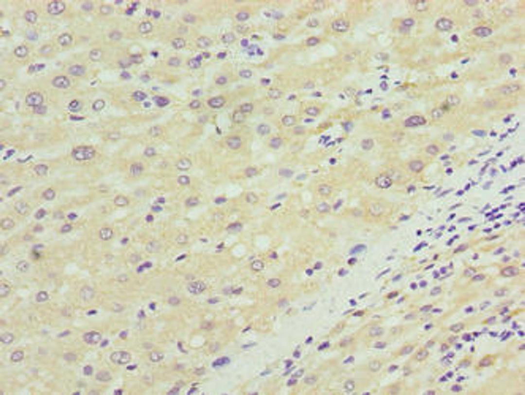 Immunohistochemistry of paraffin-embedded human liver cancer using CSB-PA818240LA01HU at dilution of 1:100