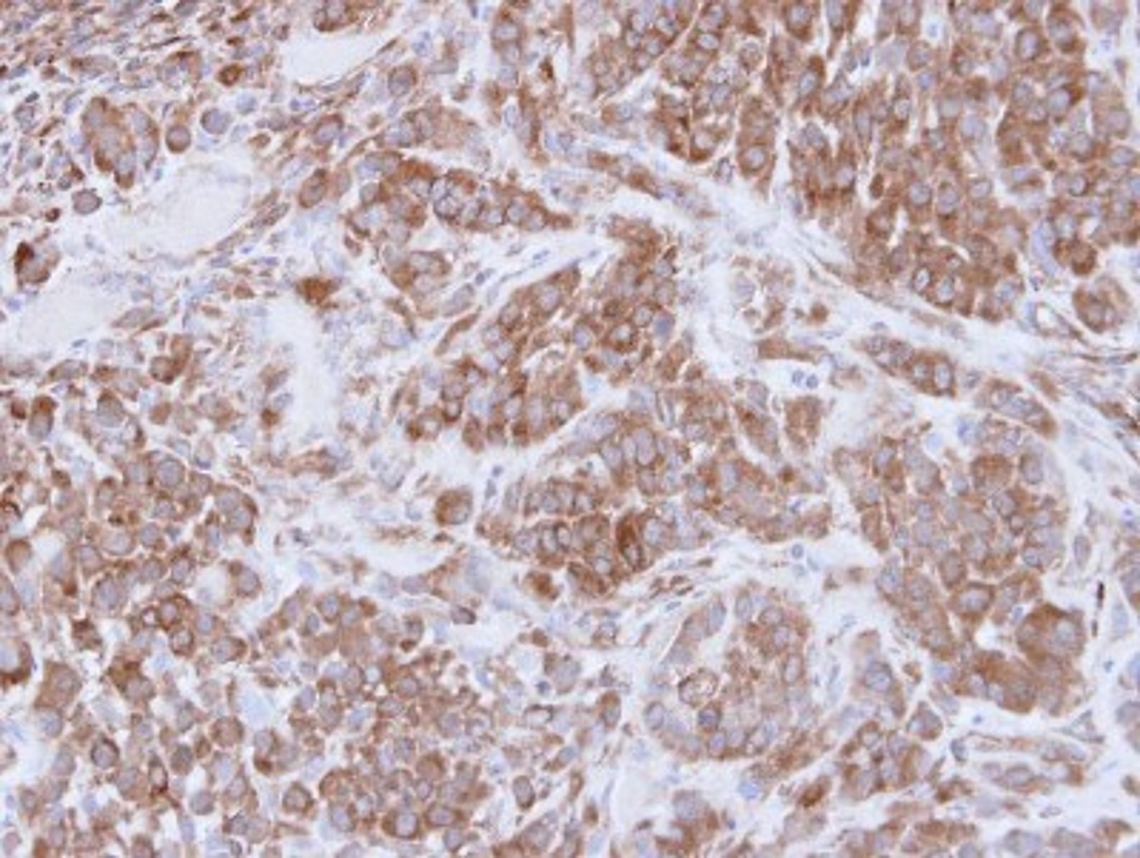 Immunohistochemistry-Paraffin: MMP16 Antibody [NBP1-33102] - Paraffin-embedded A549 xenograft, using antibody at 1:100 dilution.