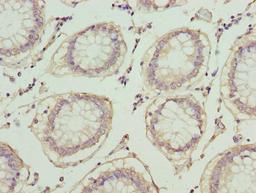 Immunohistochemistry of paraffin-embedded human colon cancer using CSB-PA08917A0Rb at dilution of 1:100