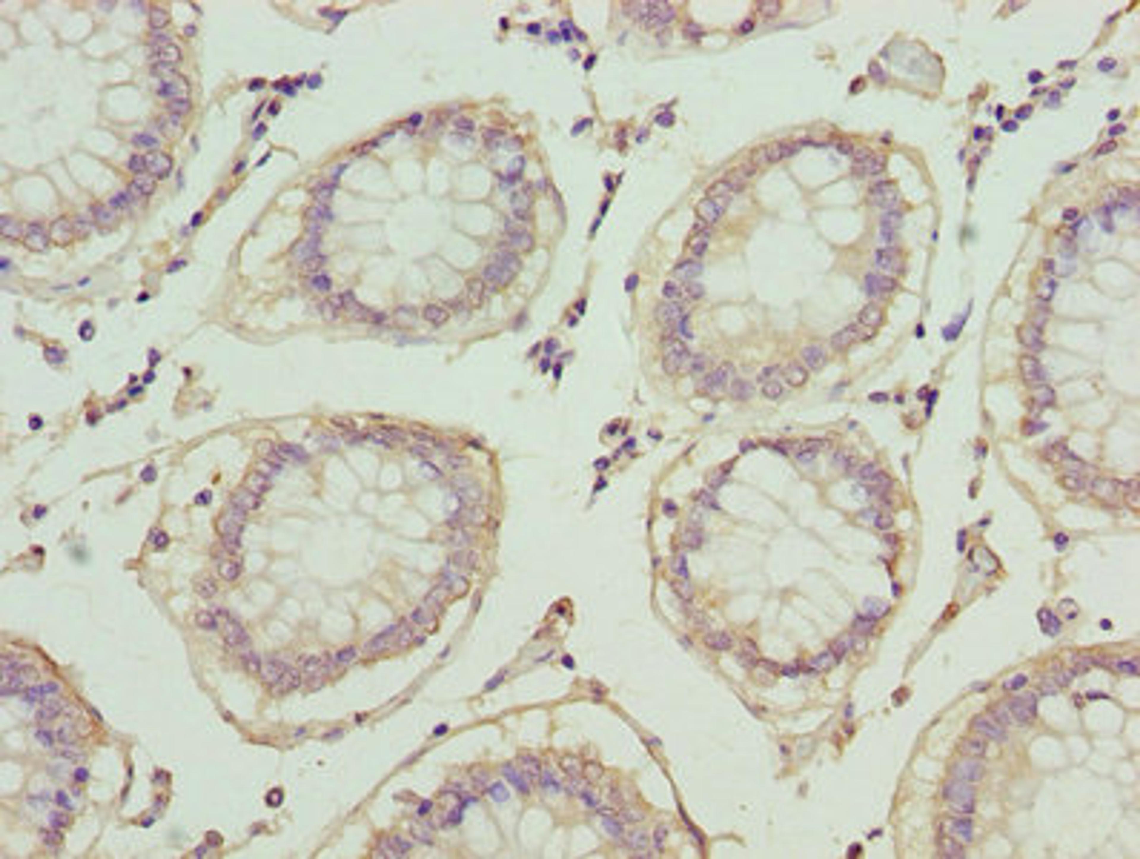 Immunohistochemistry of paraffin-embedded human colon cancer using CSB-PA08917A0Rb at dilution of 1:100