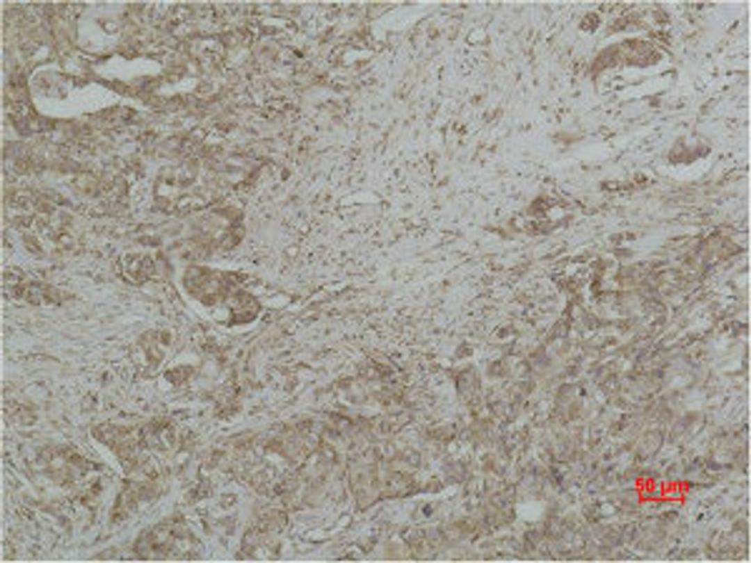 Immunohistochemical analysis of paraffin-embedded human Breast caricnoma using CYCS Monoclonal Antibody.