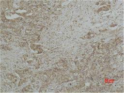 Immunohistochemical analysis of paraffin-embedded human Breast caricnoma using CYCS Monoclonal Antibody.
