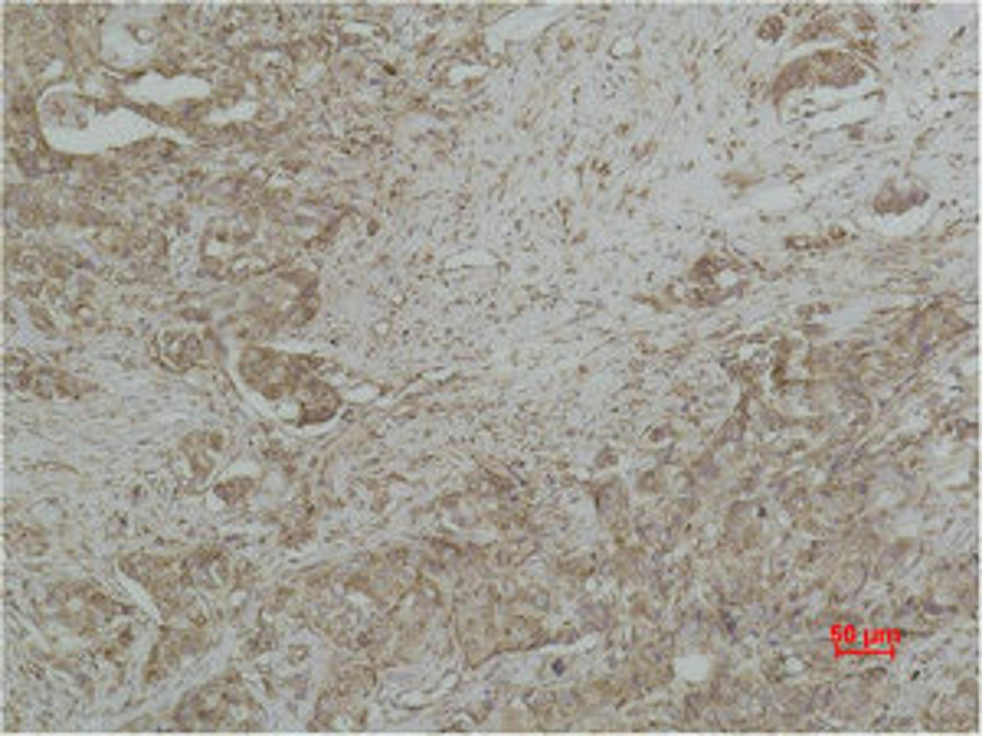 Immunohistochemical analysis of paraffin-embedded human Breast caricnoma using CYCS Monoclonal Antibody.