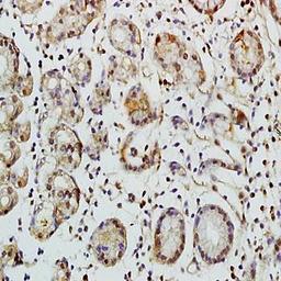 Immunohistochemical analysis of formalin-fixed and paraffin embedded human colon carcinoma tissue (dilution at:1:200) using TEM1 antibody