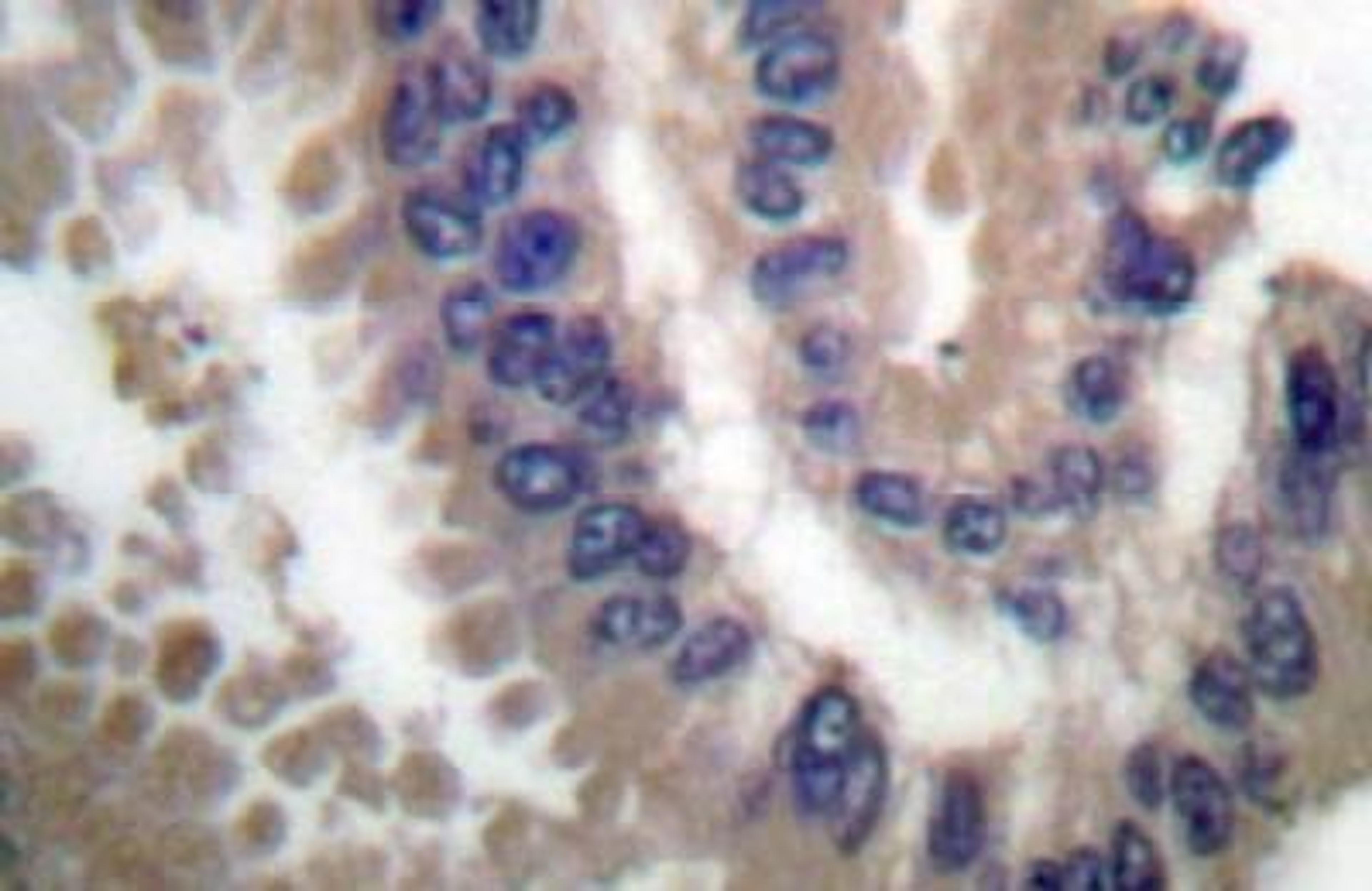 Immunohistochemistry-Paraffin: Cullin 1 Antibody [NB100-91724] - Paraffin-embedded human lung carcinoma tissue.