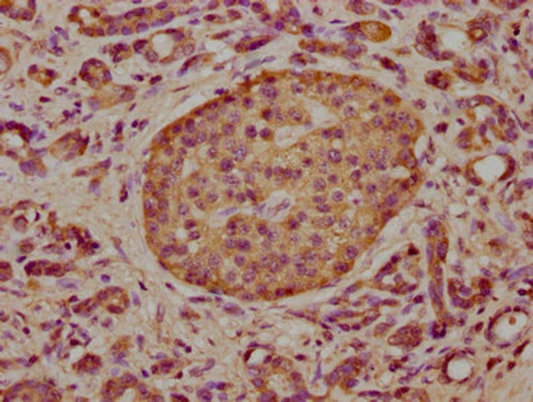 IHC image of CSB-PA008015LA01HU diluted at 1:300 and staining in paraffin-embedded human pancreatic cancer performed on a Leica BondTM system. After dewaxing and hydration, antigen retrieval was mediated by high pressure in a citrate buffer (pH 6.0). Section was blocked with 10% normal goat serum 30min at RT. Then primary antibody (1% BSA) was incubated at 4&deg;C overnight. The primary is detected by a biotinylated secondary antibody and visualized using an HRP conjugated SP system.