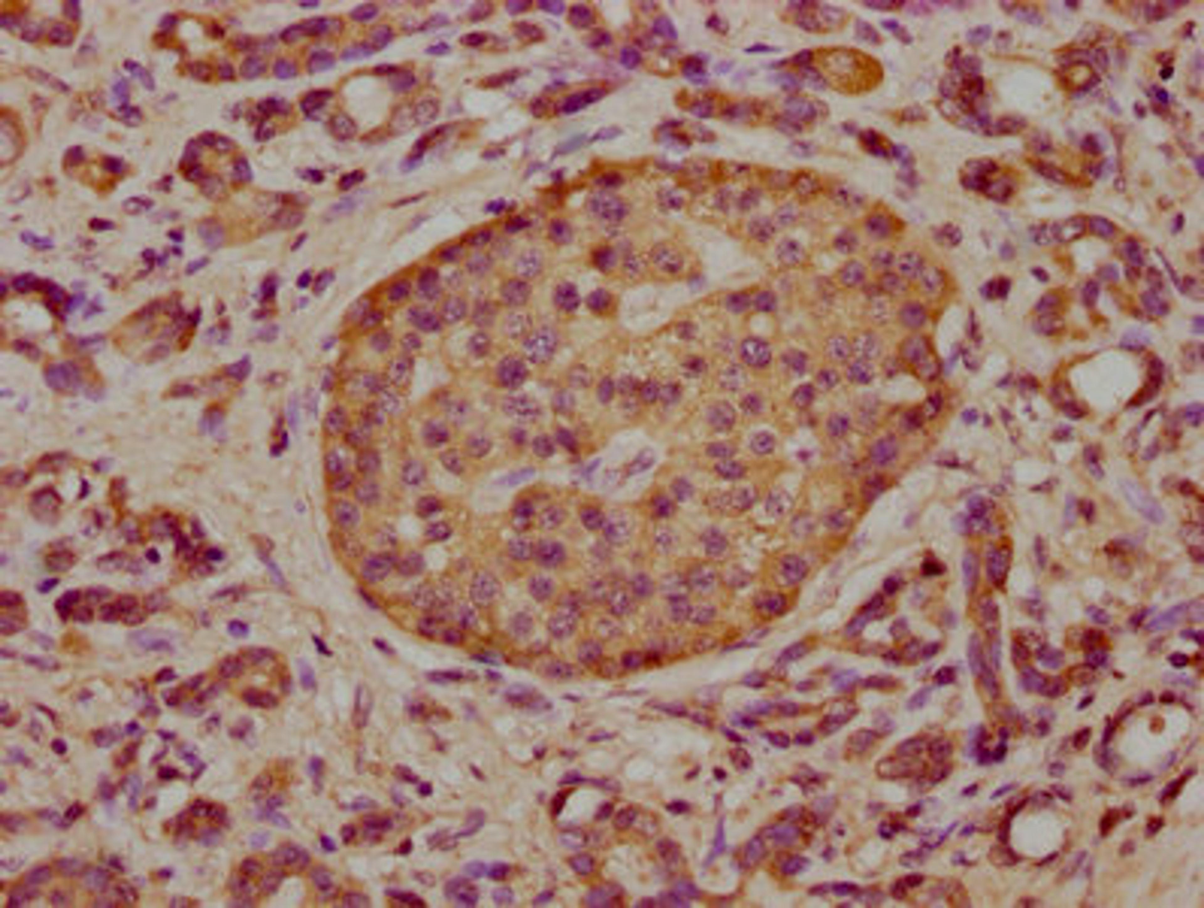 IHC image of CSB-PA008015LA01HU diluted at 1:300 and staining in paraffin-embedded human pancreatic cancer performed on a Leica BondTM system. After dewaxing and hydration, antigen retrieval was mediated by high pressure in a citrate buffer (pH 6.0). Section was blocked with 10% normal goat serum 30min at RT. Then primary antibody (1% BSA) was incubated at 4&deg;C overnight. The primary is detected by a biotinylated secondary antibody and visualized using an HRP conjugated SP system.