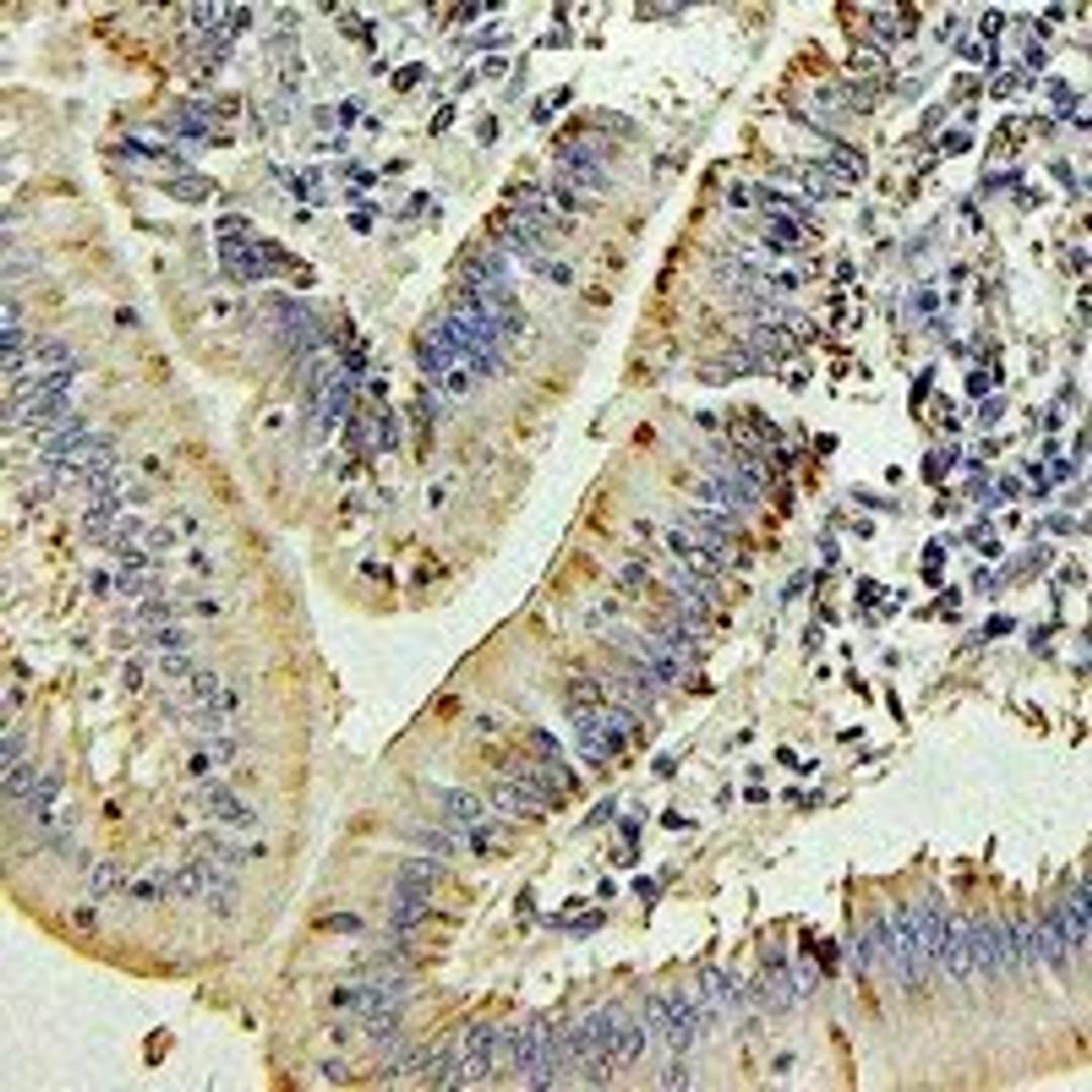 Immunohistochemical staining of human colon cancer tissue using IL27 antibody