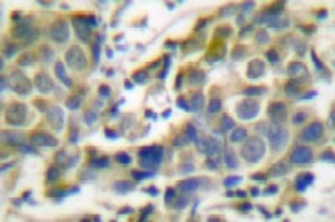 Immunohistochemistry-Paraffin: AMPK alpha 2 [p Thr183, p Thr172] Antibody [NB100-92711] - Paraffin-embedded human breast carcinoma tissue.